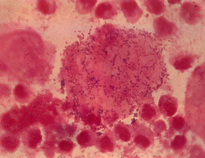 青岛细菌性阴道炎如何治疗?