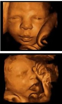 城阳做四维彩超多少钱?