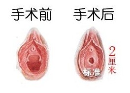 �޸���ŮĤ����Ҫע��ʲô��