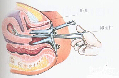 保宫人流的效果如何?